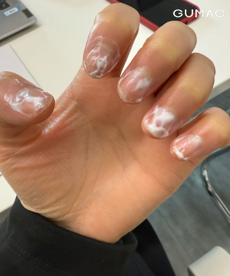 duong mong sau khi dap bot