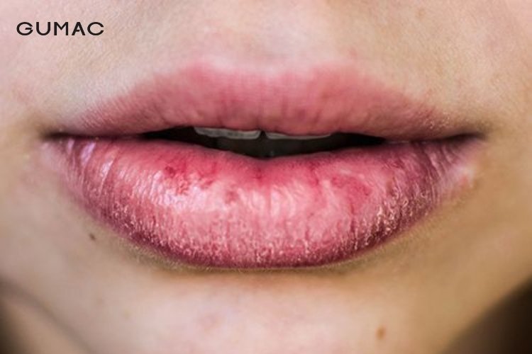 Hạn chế bặm môi